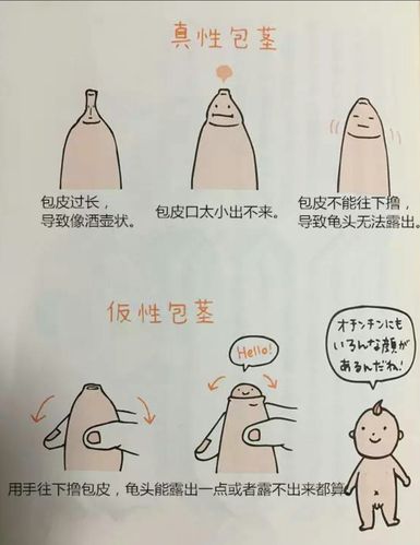 小儿包皮过长包茎怎么办