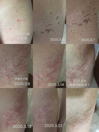 玫瑰糠疹的自愈以及平时要注意的 ?