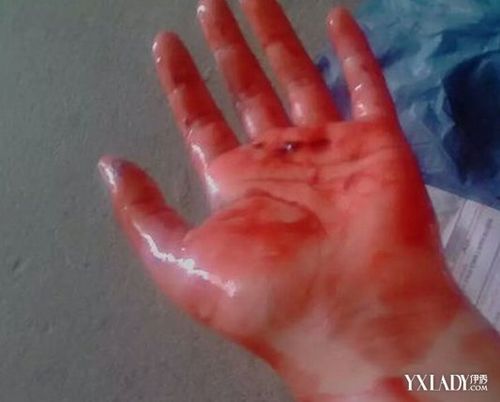 【图】手臂流血的照片大盘点 4大步骤教你快速止血