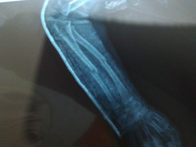 孩子七岁,晚上玩耍时小胳膊摔了,骨折了