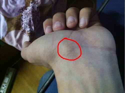 手腕长了个硬包