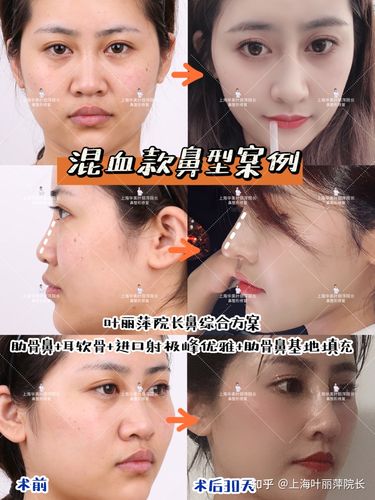 请问一下我这样是鼻基底凹陷吗咋改善