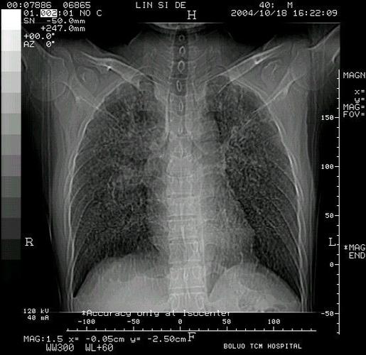 矽肺|肺及下呼吸道-医影在线-专业权威的医学影像交流