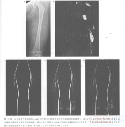 低流速脉管畸形的影像学表现-磁共振成像