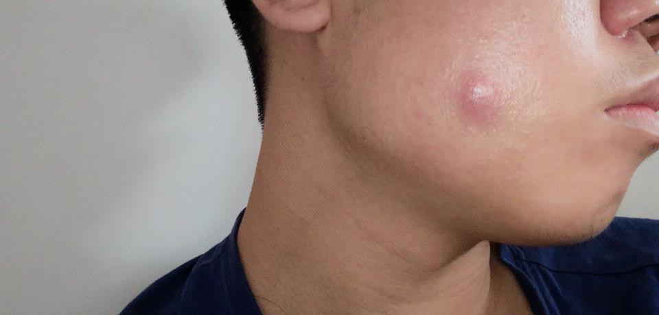 脸上不知道这是痘痘还是毛囊炎 有点大 有点痛 怎么治疗