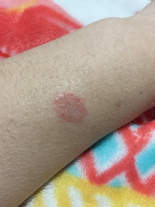 各位亲们,我想知道这个是什么阿,是癣吗?好急啊!