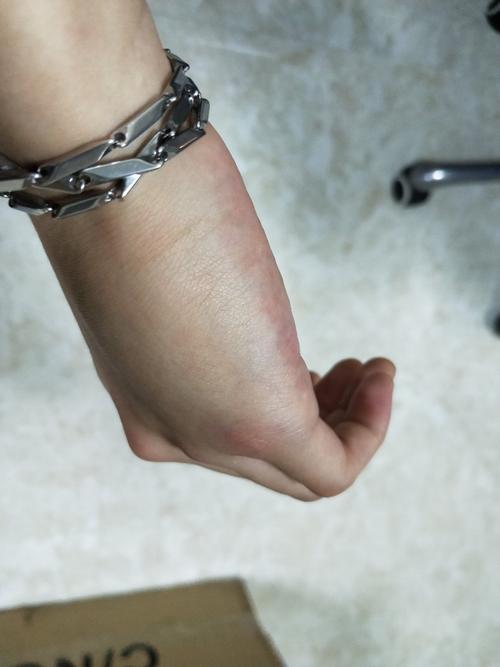 前几日 喝醉了 手很用力锤了一下墙壁 到现在还很痛 肿消了