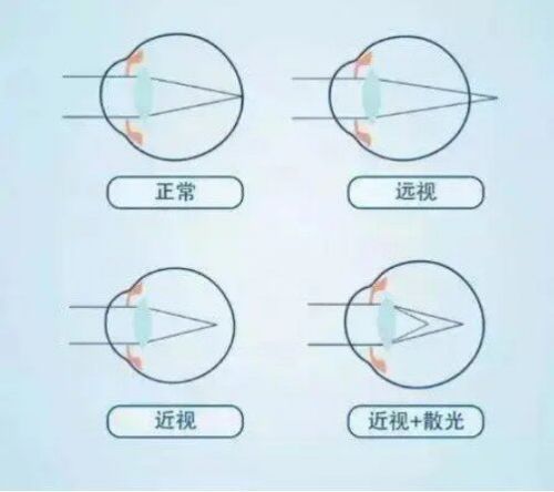 同仁医院郑远远教授为什么孩子近视了还会有散光