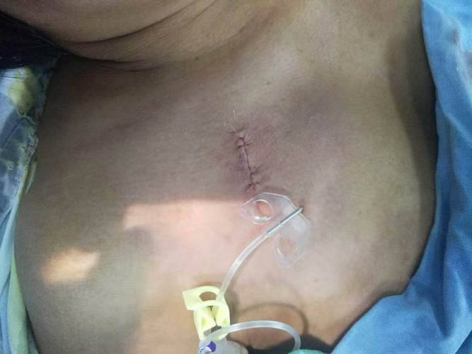 (2) 禁忌证:            ①出血倾向,禁忌行锁骨下深静脉穿刺