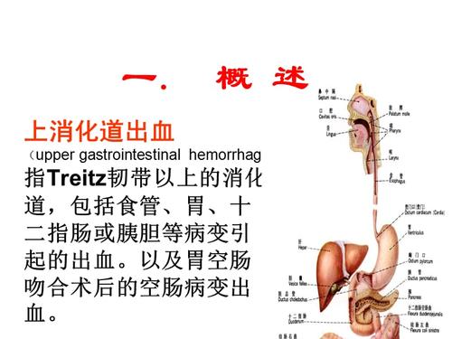 上消化道出血ppt
