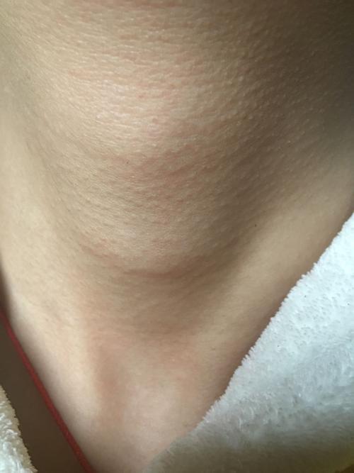 13岁女 感觉喉结很明显 同学有时会嘲笑我 怎么办?好急