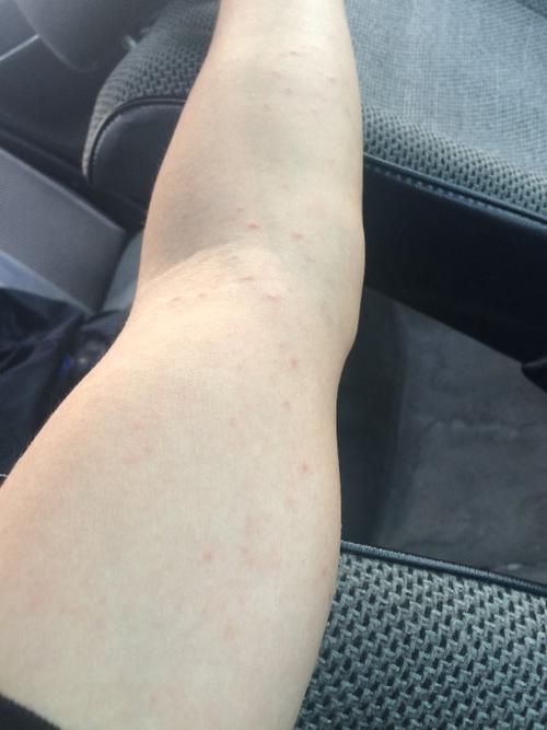 这种是不是梅毒皮疹?不痛不痒