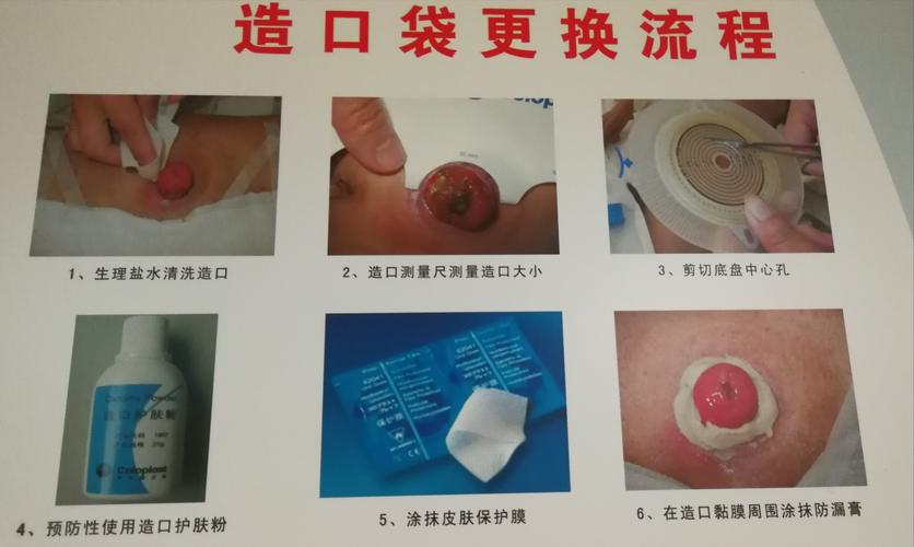 肠造口术后护理及注意事项