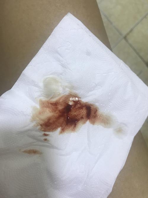 排17 早孕出血,已经出血第五天了,着床出血会这么久吗?