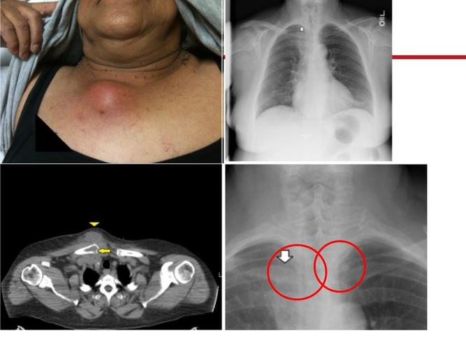 胸锁关节感染的外科治疗