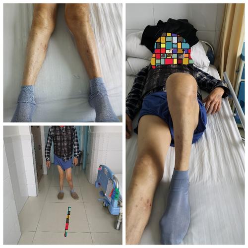 术前查体:双膝关节外翻畸形,左侧伸20度,屈100度,屈膝外翻消失,侧方