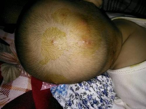 脓包疮的症状的照片 (35)