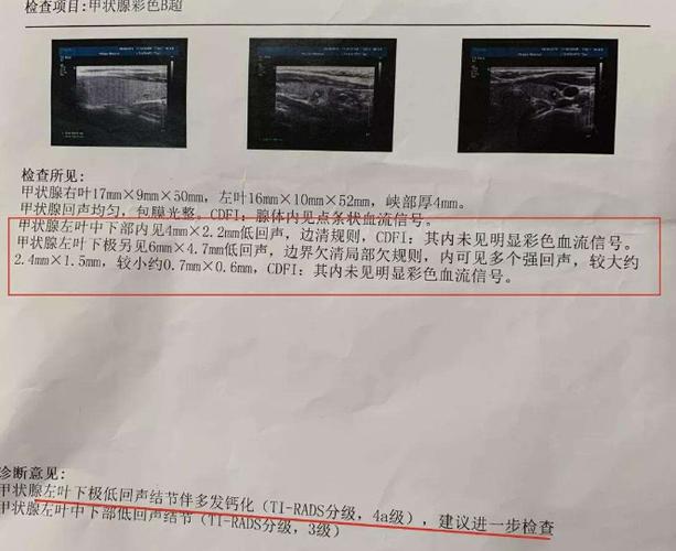 甲状腺结节钙化是怎么回事?结节钙化就是癌变吗?饮食该注意什么