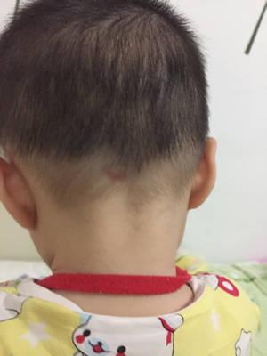 你好,我宝宝七个月了,最近发现他后脑勺有块红的,有时候又大一点,有