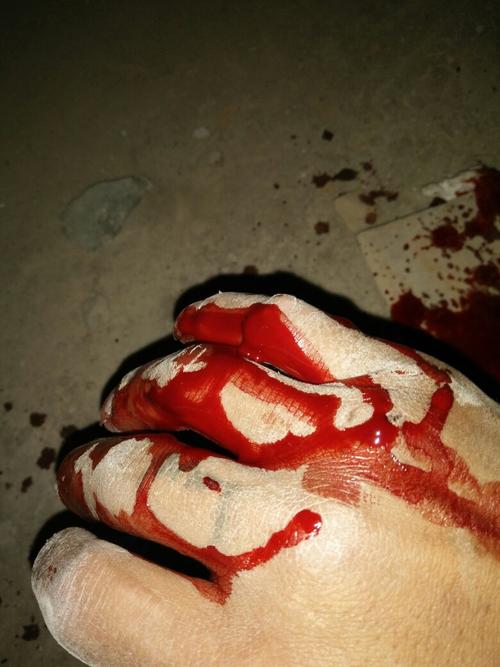 我昨天在工地上,上班不小受伤了,伤得产重老板只赔偿一千块钱,我不