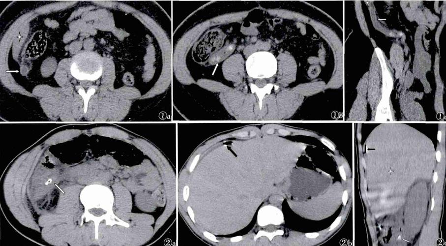 文摘:高位急性阑尾炎的临床及 ct 诊断分析