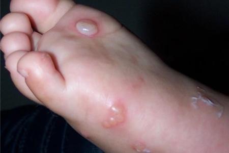 脚上起水泡怎么办 如何避免脚上起水泡