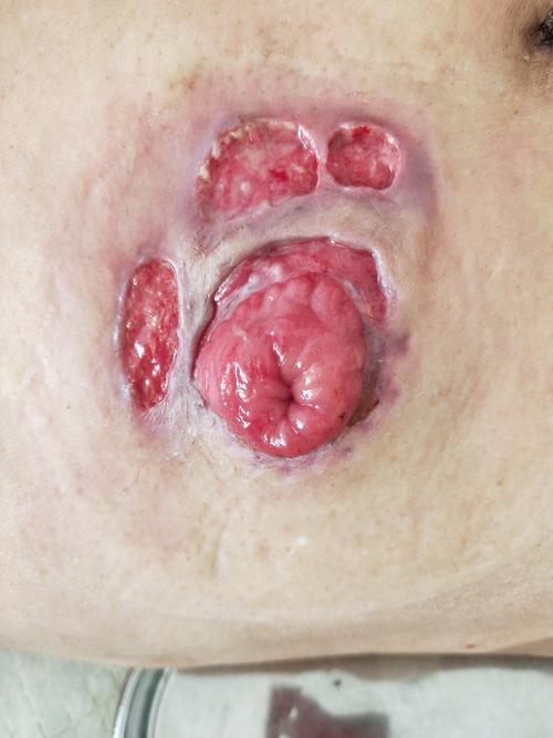 造口护理案例分享