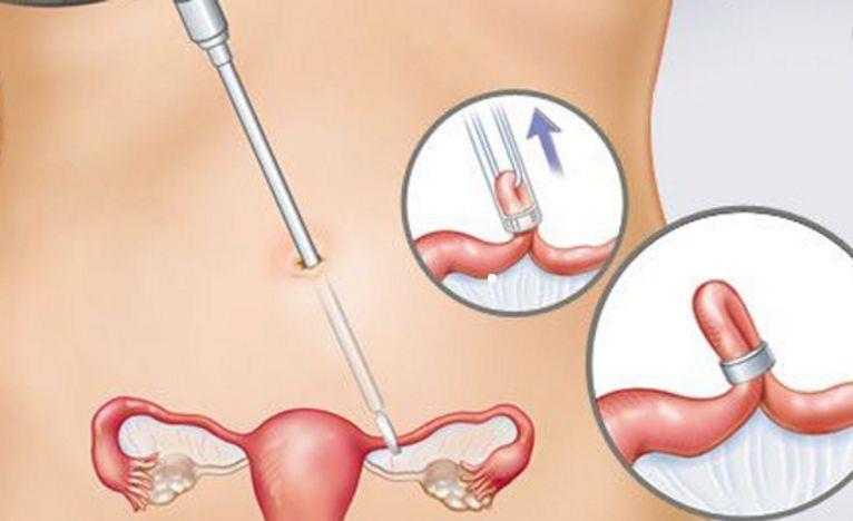 原来女人做结扎手术会有这么多影响可惜还有很多人不知道