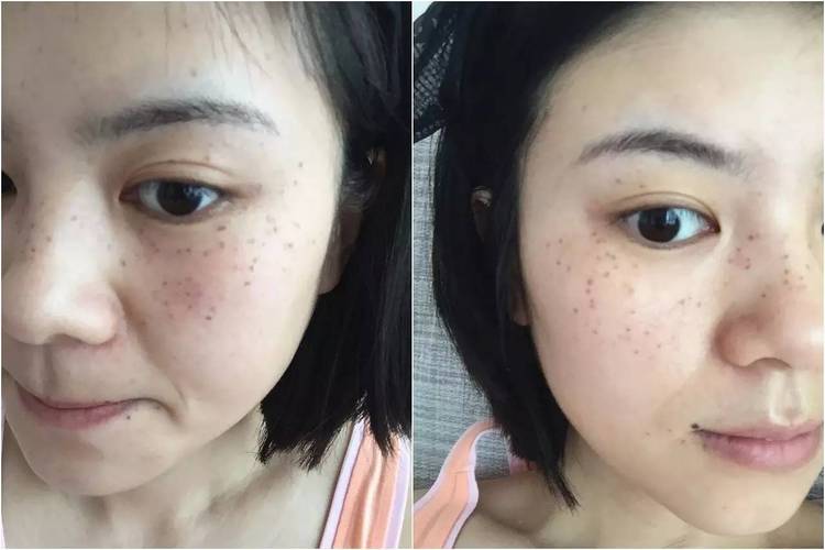 怎样去掉脸上的黄褐斑黄褐斑如何消除