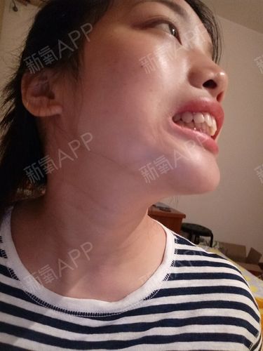 图一下牙都被上牙给包住了,医生说的有点深覆合,你看侧面就