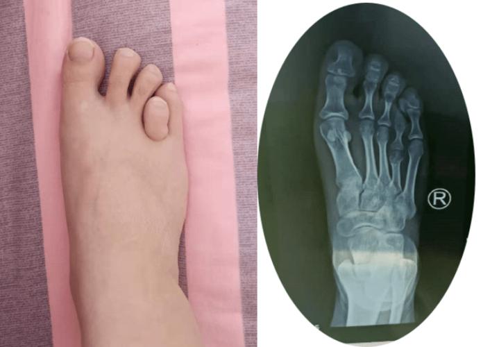 【河南省足踝专家会诊】脚趾短小让她自卑多年,专家一番话后