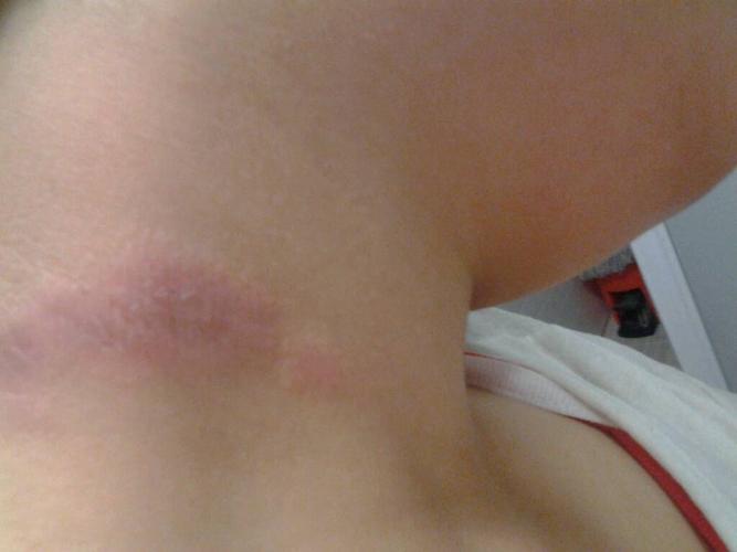 问:脖子上这是怎么了?是过敏吗?