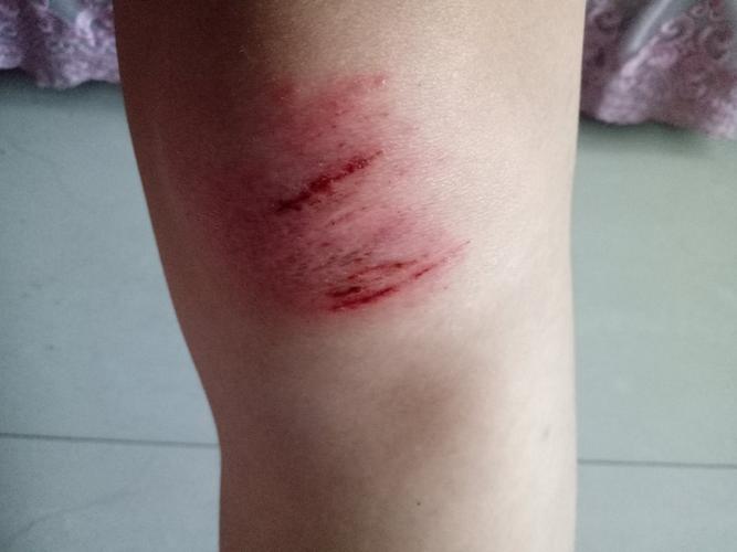 今天跑步受伤了