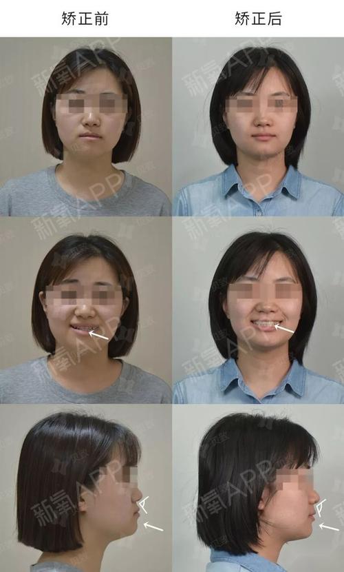 19个月纠正骨性地包天还少女灿烂笑容