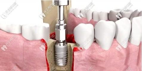 想知道厦门麦芽口腔种植牙怎么样,顺便了解下姚院长