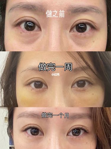 内切眼袋脂肪填泪沟术后一个月对比_眼袋_疼痛感_南方医科大学深圳