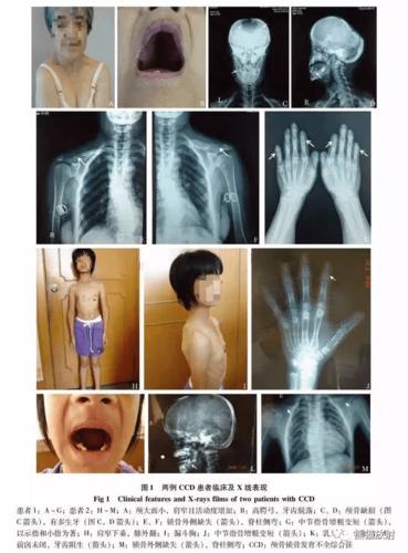 但常伴有颅骨或其它骨骼发育畸形,构成颅骨锁骨发育不全综合征