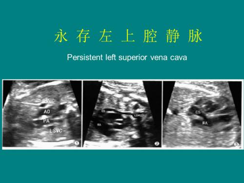 永存左上腔静脉