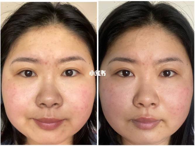 m22 aopt 超光子嫩肤 第二次对比_光子嫩肤_面霜_薇诺娜怎么样_面膜