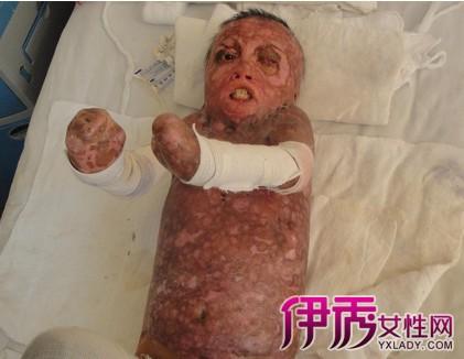 看到烧伤图片觉得遗憾 熟知急救处理的方法才能轻松应对