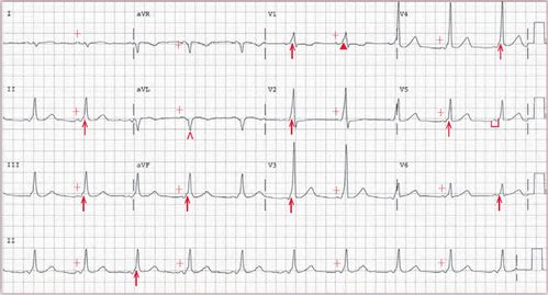 四个病例带你吃透预激综合征心电图