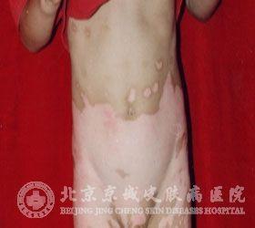 外阴白斑的典型症状有哪些_白癜风_北京京城皮肤病