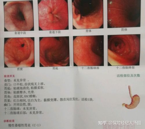 确诊慢性萎缩性胃炎,还能买到保险吗?(附真实成功投保