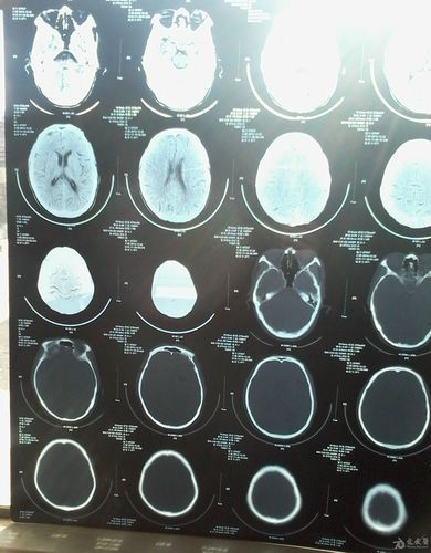 [病例讨论] 应该考虑脑萎缩吗