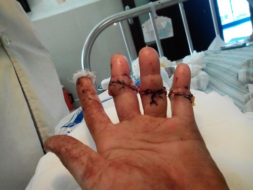 左手断三根手指(中无小)已经接好复活请问伤残能鉴定为几级.