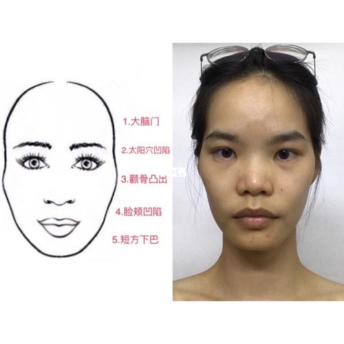 发际线高,脑门大,太阳穴凹陷,颧骨高77凸出
