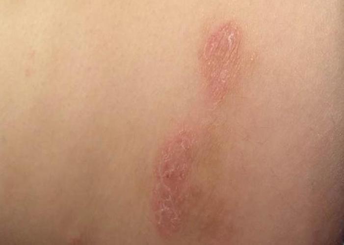 皮肤癣科普介绍 