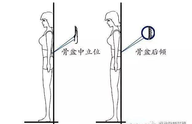 小肚子突出?屁股扁平?原来是骨盆后倾!