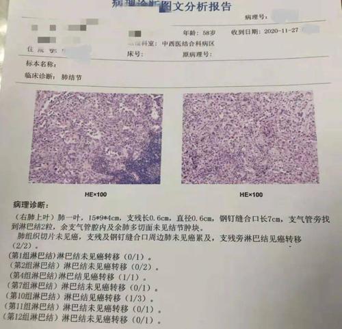 最新循证医学证据指导下的肺癌术后辅助治疗 ——1例n2患者术后治疗的