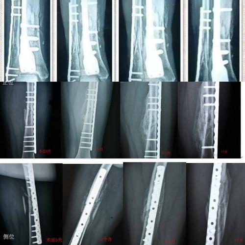 象楠百科:骨折愈合的四个时期